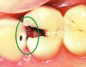 C2の虫歯術前
