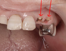 C3の虫歯術前