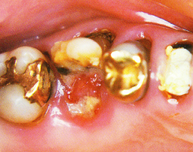 C4の虫歯術前