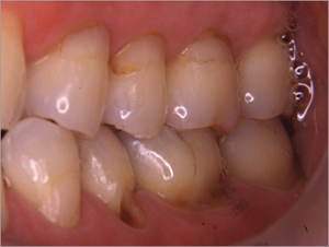 エナメル質が削れている状態の歯