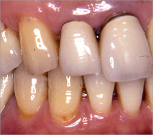 歯茎が退縮している状態の歯