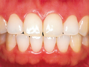 健康で正常な色の歯茎