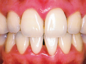 赤くぷっくら腫れている歯茎