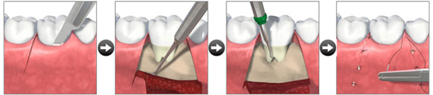 歯周病治療、外科処置の流れ