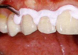 歯の表面にフッ素を塗布し虫歯予防